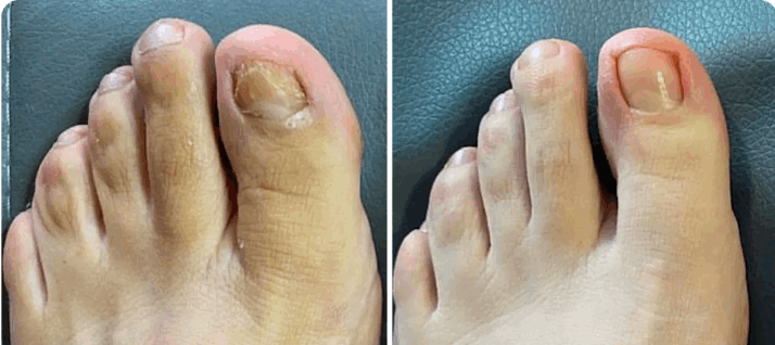 What is Orevelle Nail Fungus Pen – Orevelle