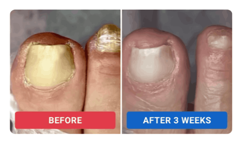 Orevelle Nail Fungus Pen review by Elena S. – Orevelle