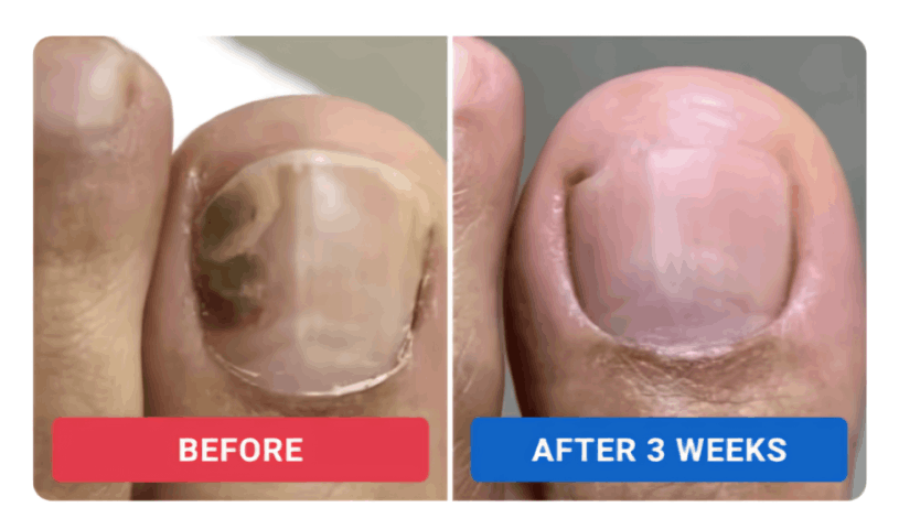 Orevelle Nail Fungus Pen review by Rachel M. – Orevelle
